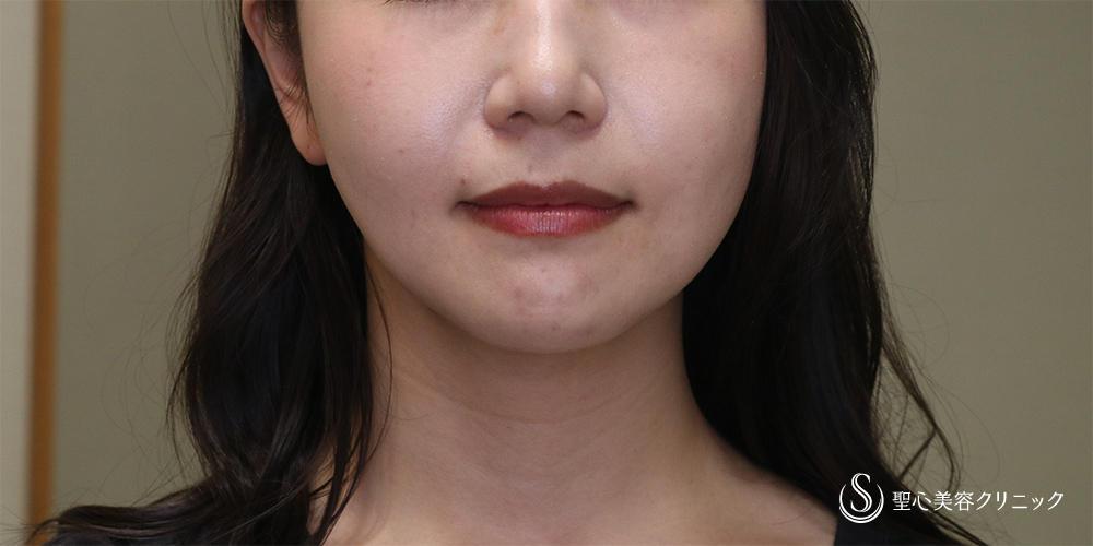 【20代女性・シャープなフェイスラインに】脂肪吸引(顎下)(1か月後) After 
