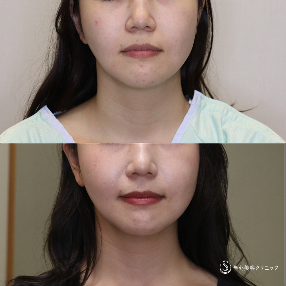 【20代女性・シャープなフェイスラインに】脂肪吸引(顎下)(1か月後) After 