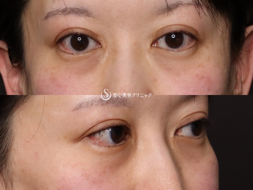 【40代女性・目の下のクマ、たるみ】プレミアムPRP皮膚再生療法(処置後9か月) Before 