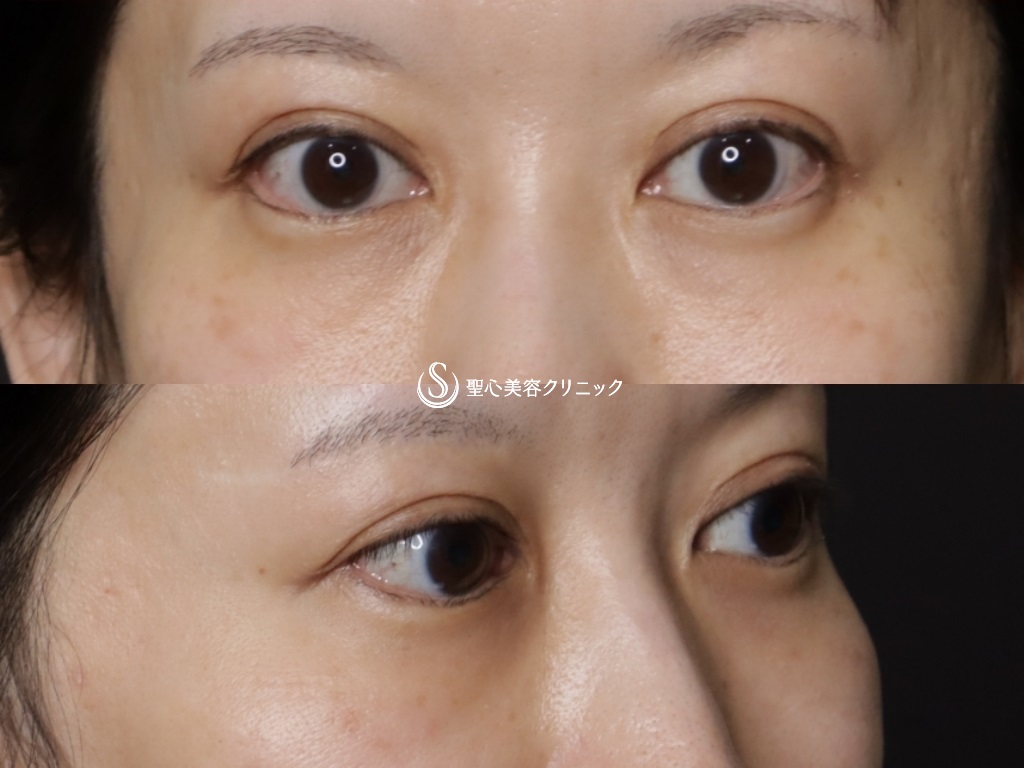 【40代女性・目の下のクマ、たるみ】プレミアムPRP皮膚再生療法(処置後9か月) After 