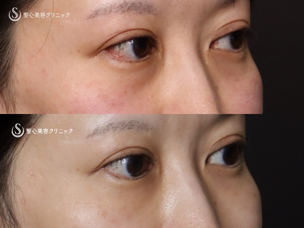 【40代女性・目の下のクマ、たるみ】プレミアムPRP皮膚再生療法(処置後9か月) After 