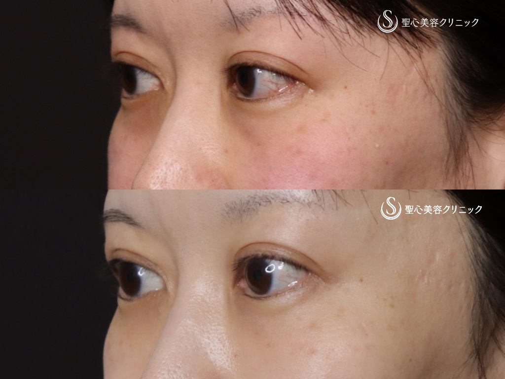 【40代女性・目の下のクマ、たるみ】プレミアムPRP皮膚再生療法(処置後9か月) After 