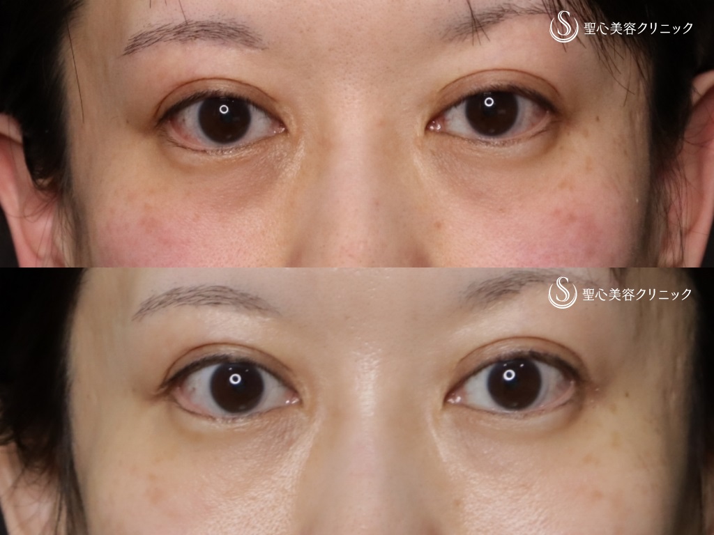 【40代女性・目の下のクマ、たるみ】プレミアムPRP皮膚再生療法(処置後9か月) After 