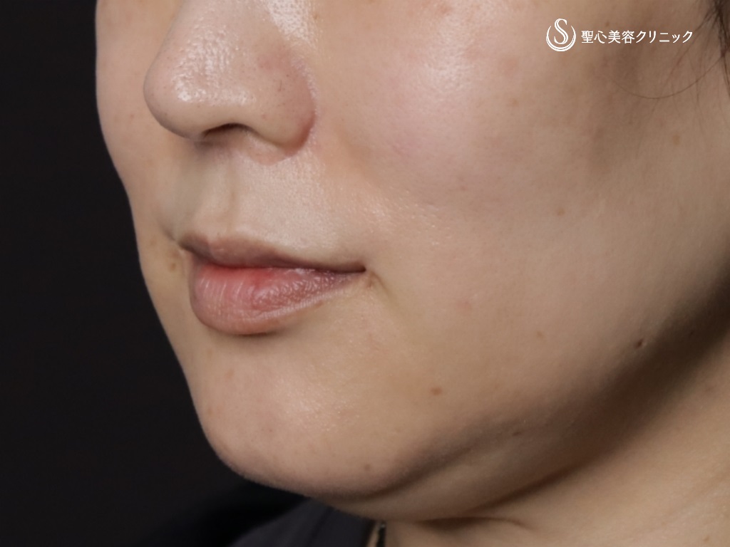 【40代女性・法令線とマリオネットラインの治療】プレミアムPRP皮膚再生療法(治療後9か月) After 