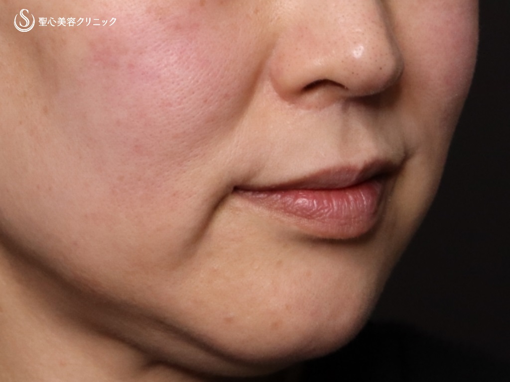 【40代女性・法令線とマリオネットラインの治療】プレミアムPRP皮膚再生療法(治療後9か月) Before 