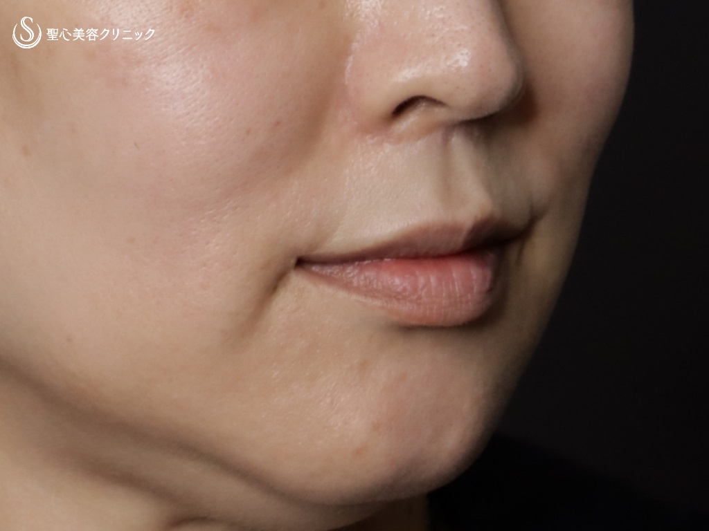【40代女性・法令線とマリオネットラインの治療】プレミアムPRP皮膚再生療法(治療後9か月) After 