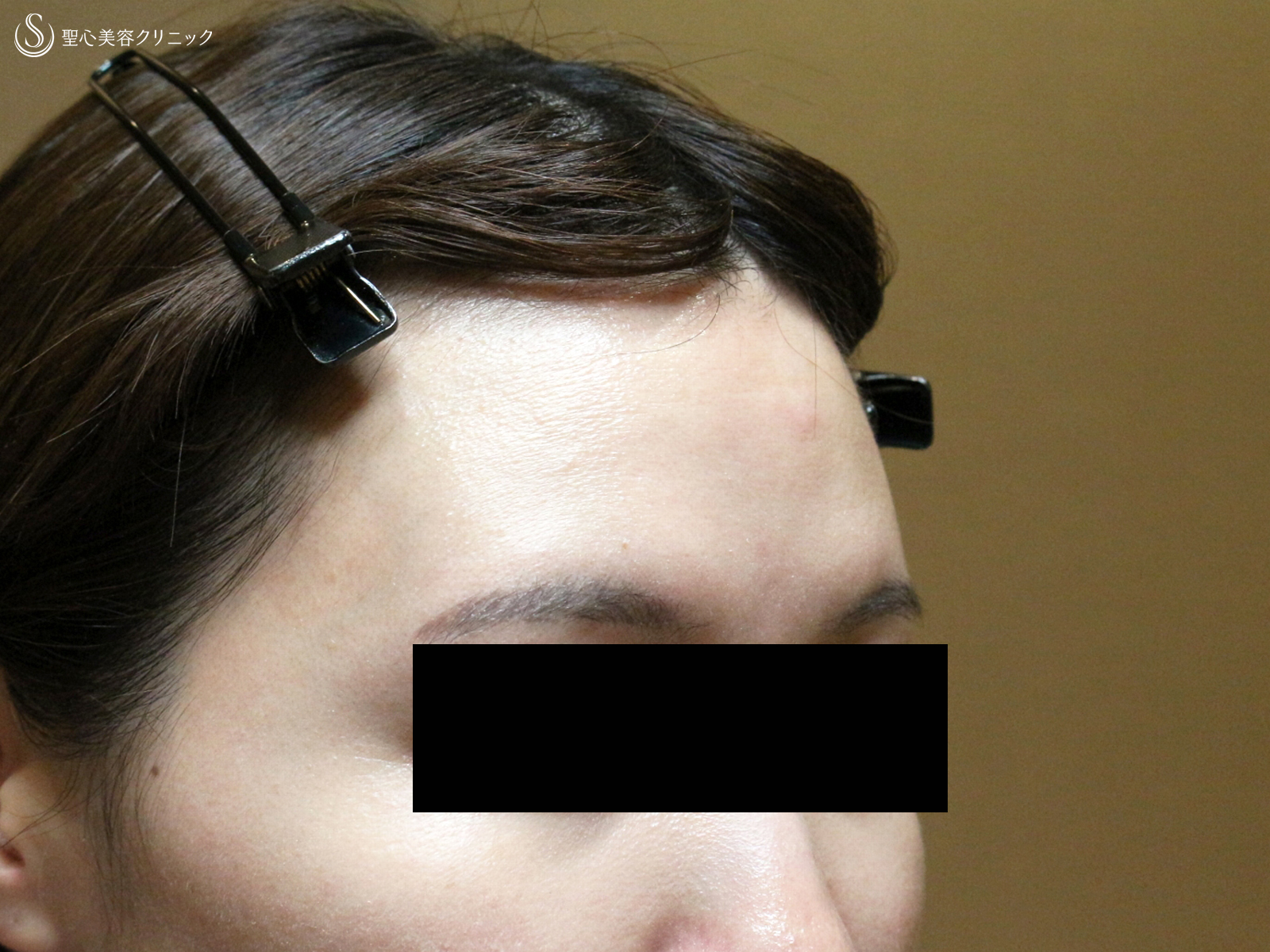 【30代女性・女性らしい丸いオデコをつくる】プレミアムPRP皮膚再生療法（直後〜6ヶ月後） Before 