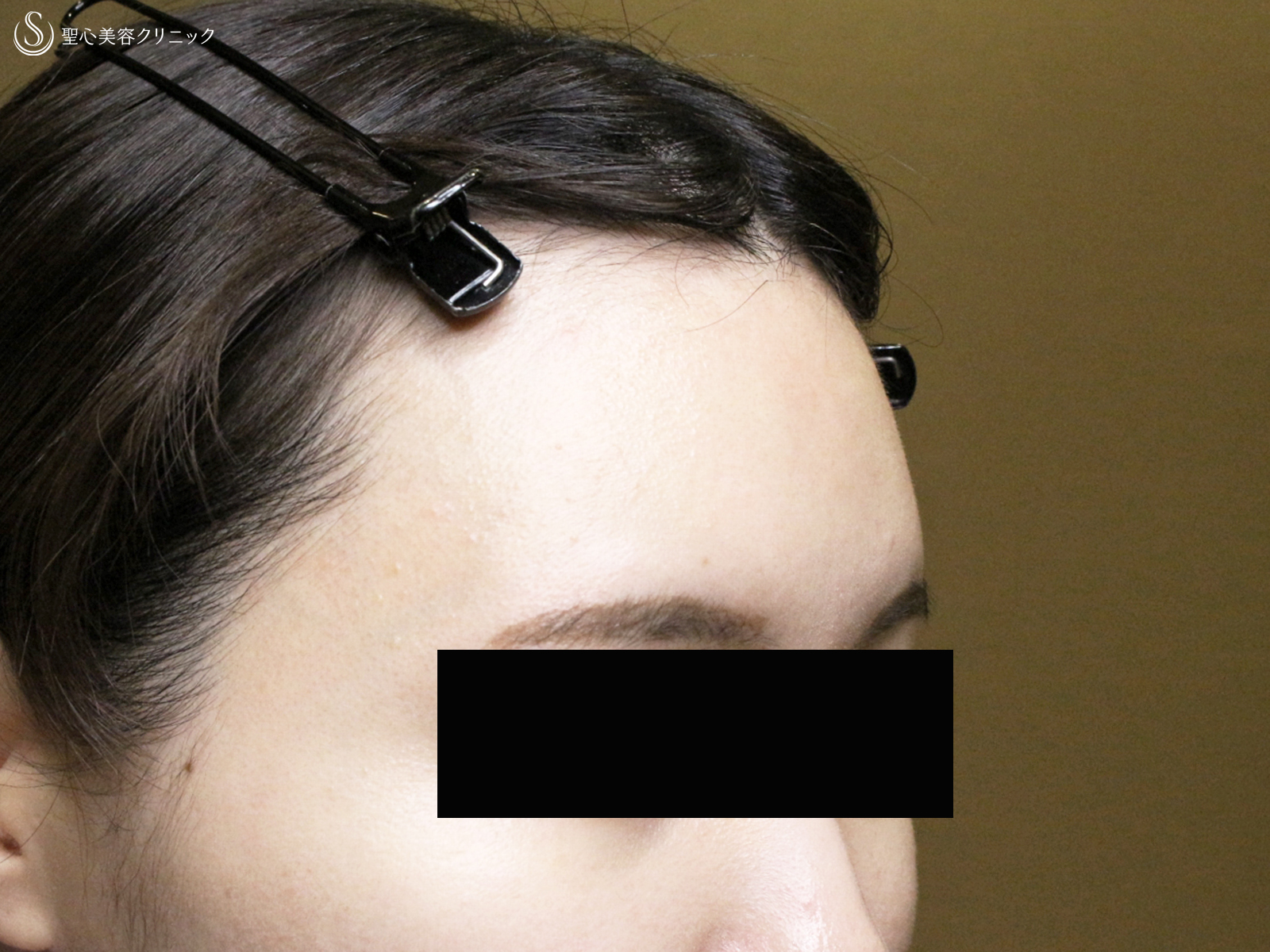 【30代女性・女性らしい丸いオデコをつくる】プレミアムPRP皮膚再生療法（直後〜6ヶ月後） After 