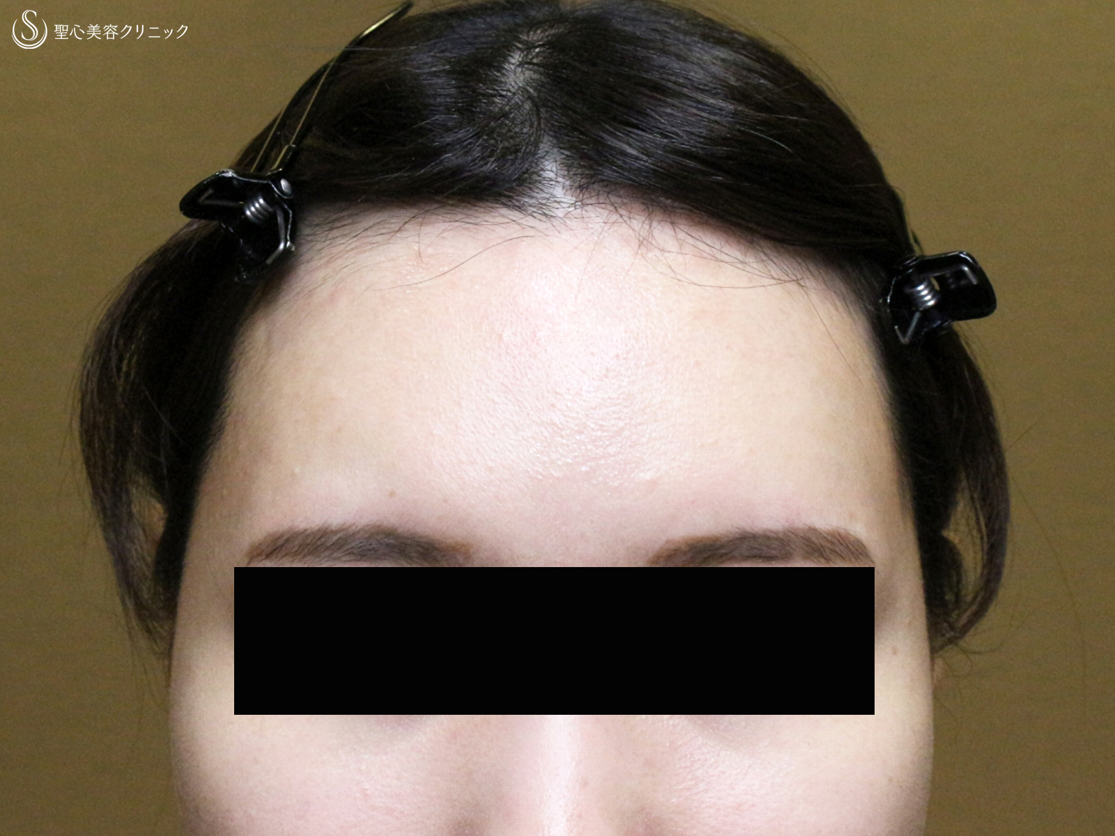 【30代女性・女性らしい丸いオデコをつくる】プレミアムPRP皮膚再生療法（直後〜6ヶ月後） After 