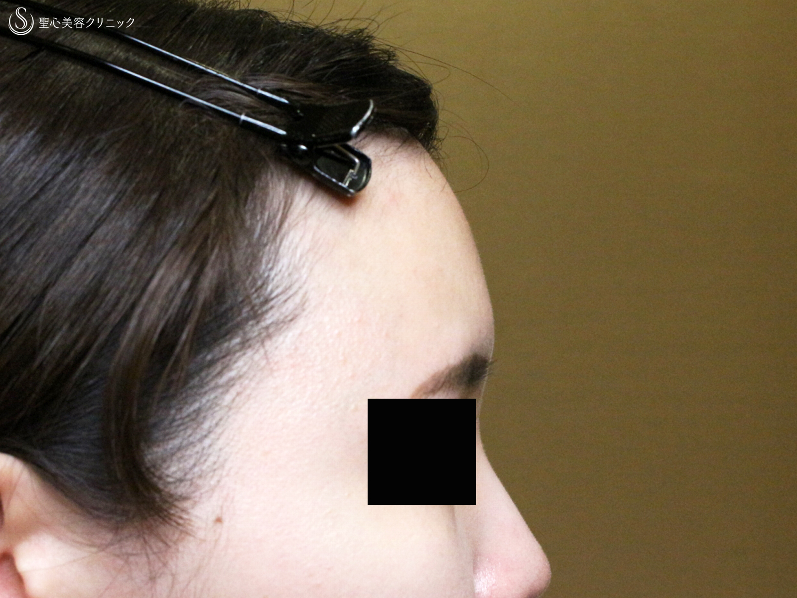 【30代女性・女性らしい丸いオデコをつくる】プレミアムPRP皮膚再生療法（直後〜6ヶ月後） After 