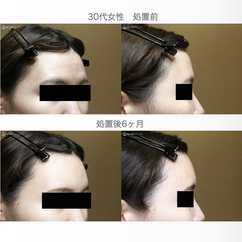 【30代女性・女性らしい丸いオデコをつくる】プレミアムPRP皮膚再生療法（直後〜6ヶ月後） After 