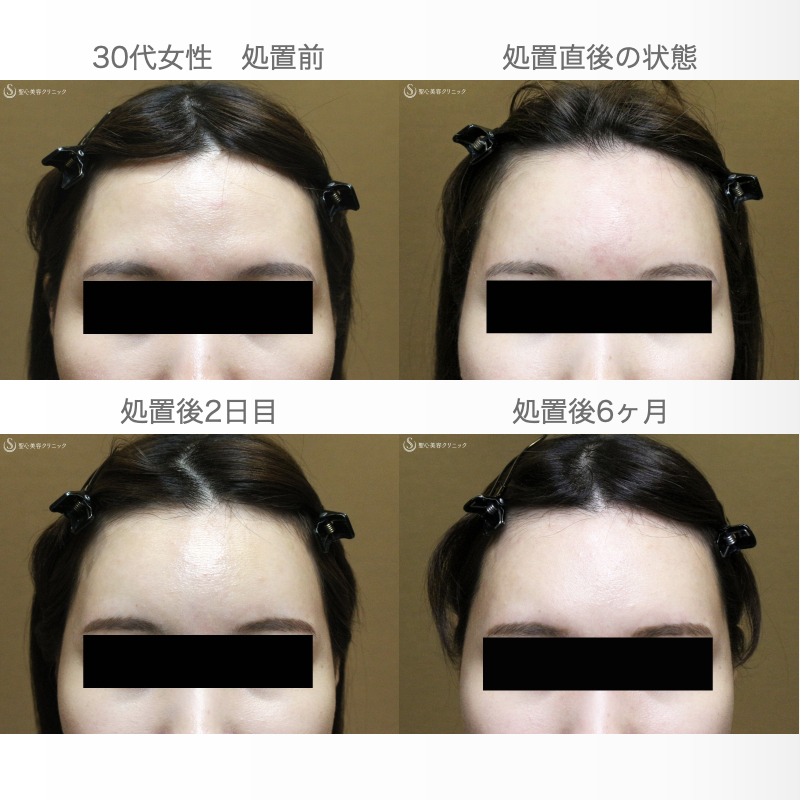 【30代女性・女性らしい丸いオデコをつくる】プレミアムPRP皮膚再生療法（直後〜6ヶ月後） Before 