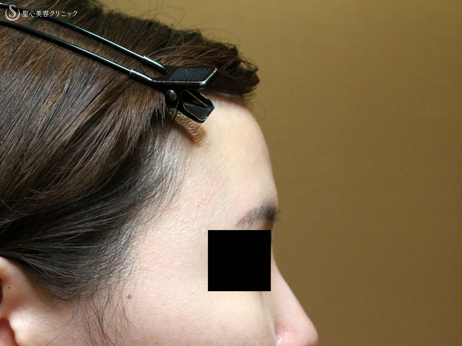 【30代女性・女性らしい丸いオデコをつくる】プレミアムPRP皮膚再生療法（直後〜6ヶ月後） Before 