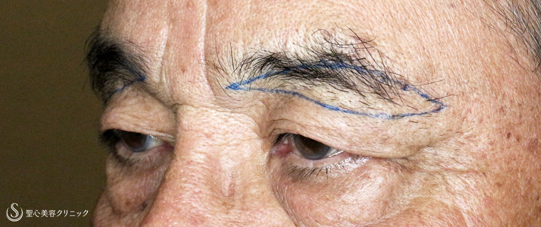 【79歳男性・数十年前の目元に戻り視界も良好】眉下リフト+α（1ヶ月後） Before 