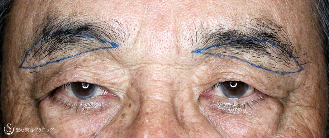 【79歳男性・数十年前の目元に戻り視界も良好】眉下リフト+α（1ヶ月後） Before 