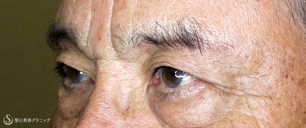 【79歳男性・数十年前の目元に戻り視界も良好】眉下リフト+α（1ヶ月後） After 