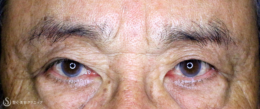 【79歳男性・数十年前の目元に戻り視界も良好】眉下リフト+α（1ヶ月後） After 