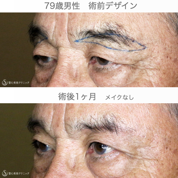 【79歳男性・数十年前の目元に戻り視界も良好】眉下リフト+α（1ヶ月後） After 