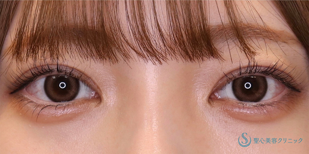 【20代女性・目を大きくパッチリに！！そして平行型に！！】眼瞼下垂(切開法/腱膜縫縮法)＋目上切開(3ヶ月後) After 