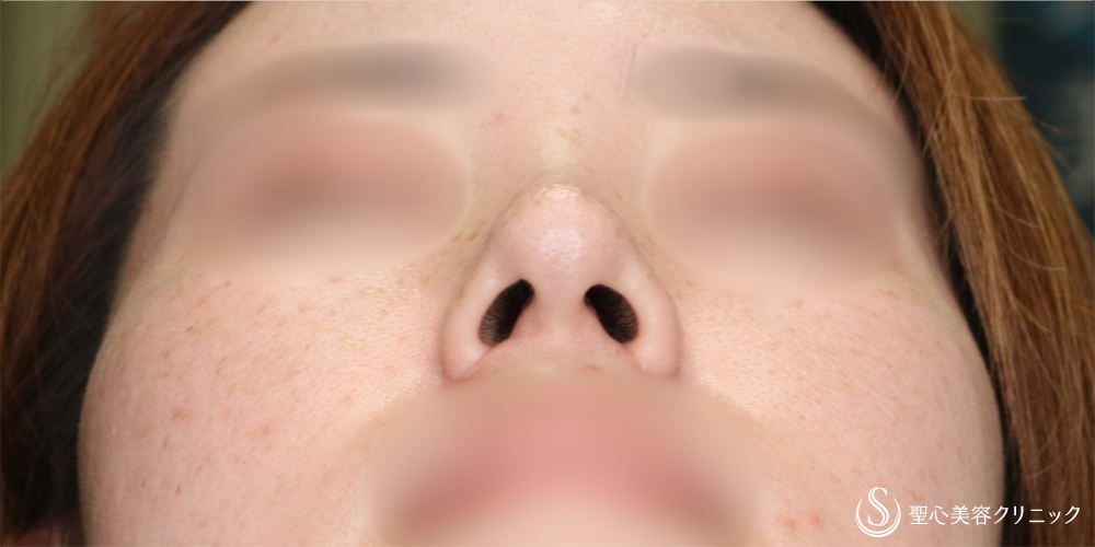 【30代女性・小鼻を小さく】小鼻縮小(術後6ヶ月後) After 