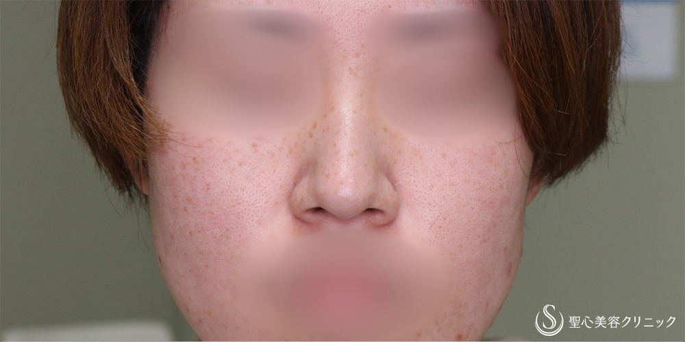 【30代女性・小鼻を小さく】小鼻縮小(術後6ヶ月後) Before 