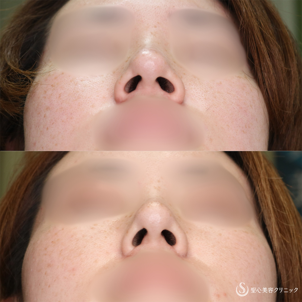 【30代女性・小鼻を小さく】小鼻縮小(術後6ヶ月後) After 