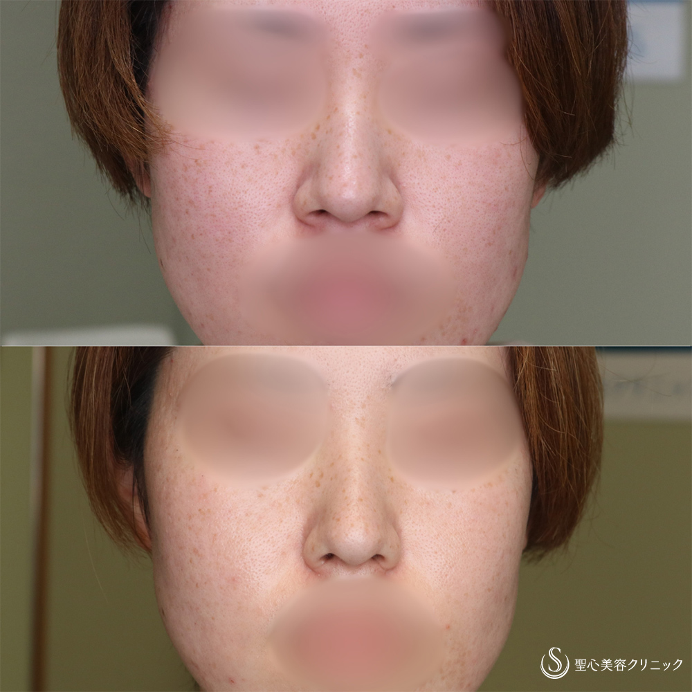 【30代女性・小鼻を小さく】小鼻縮小(術後6ヶ月後) After 
