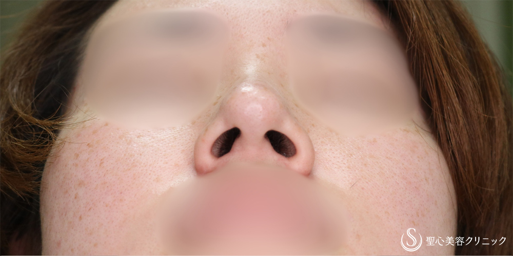 【30代女性・小鼻を小さく】小鼻縮小(術後6ヶ月後) Before 