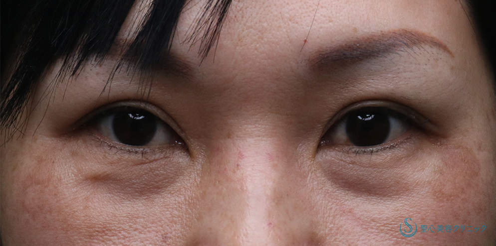 【50代女性・注射で目の下のくま取り】プレミアムPRP皮膚再生療法(3年後) Before 