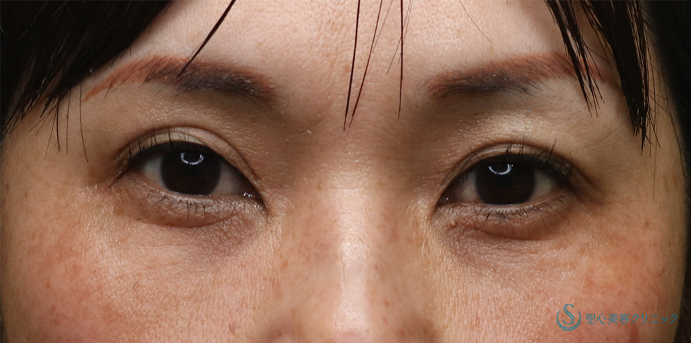 【50代女性・注射で目の下のくま取り】プレミアムPRP皮膚再生療法(3年後) After 