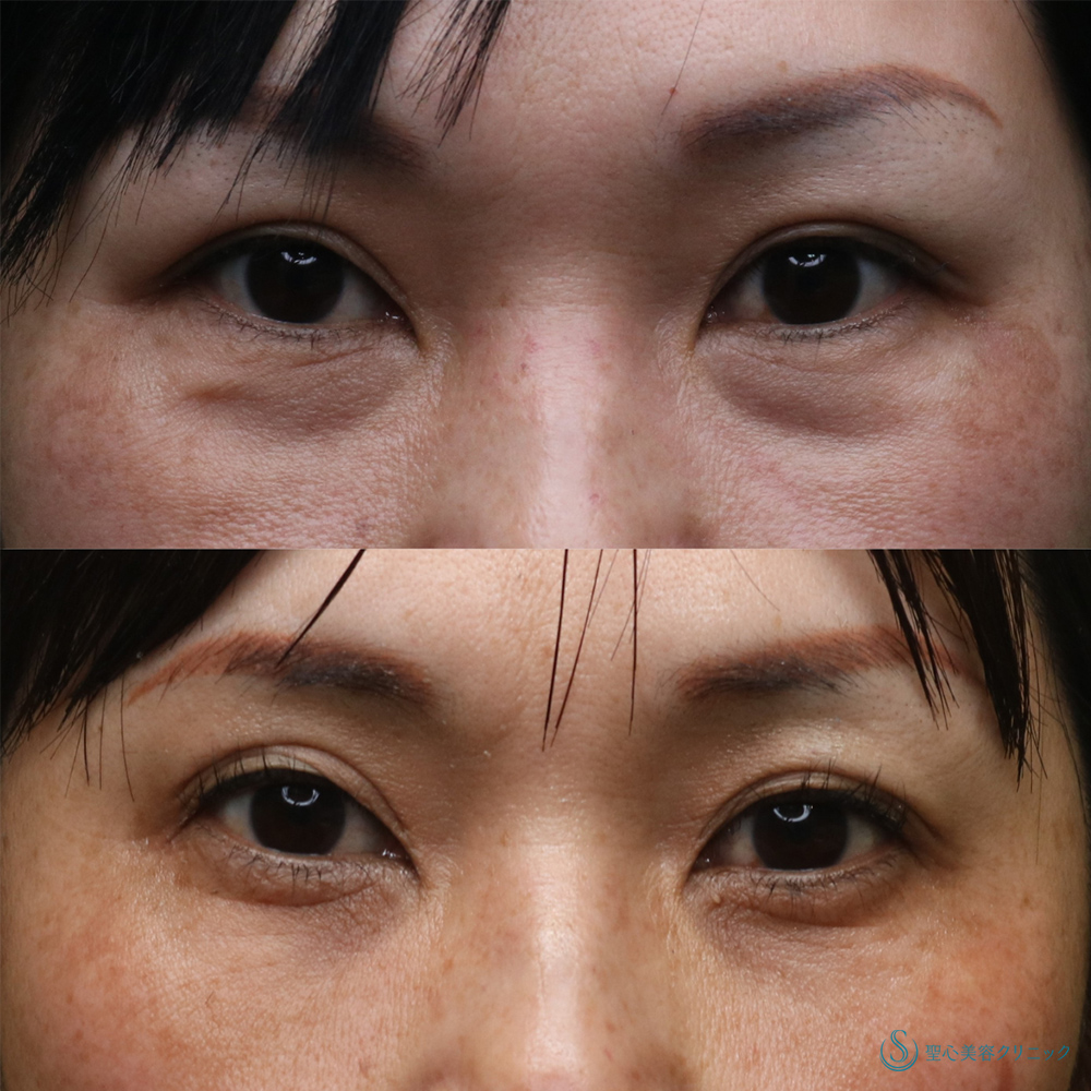 【50代女性・注射で目の下のくま取り】プレミアムPRP皮膚再生療法(3年後) After 