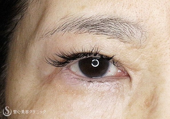 【50代女性・同じ傷でまぶたのタルミ取り】眉下リフト+α 2回目（4年後） After 