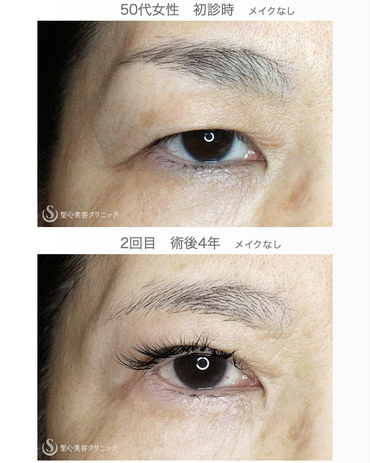 【50代女性・同じ傷でまぶたのタルミ取り】眉下リフト+α 2回目（4年後） After 