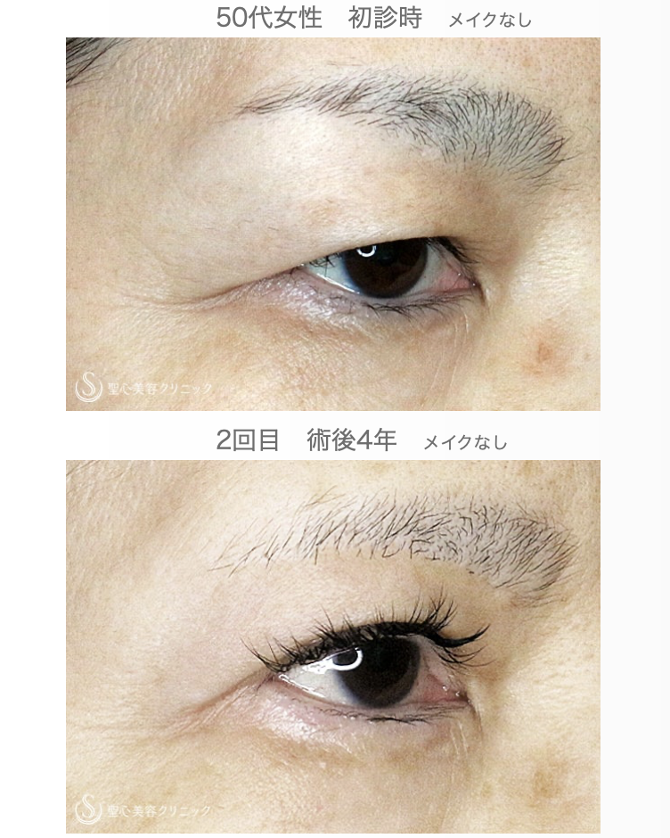 【50代女性・同じ傷でまぶたのタルミ取り】眉下リフト+α 2回目（4年後） After 
