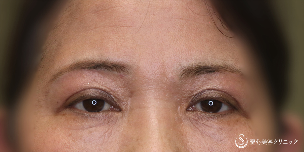 【50代女性・自然に若々しい目元に】眉下切開(術後6ヶ月) After 