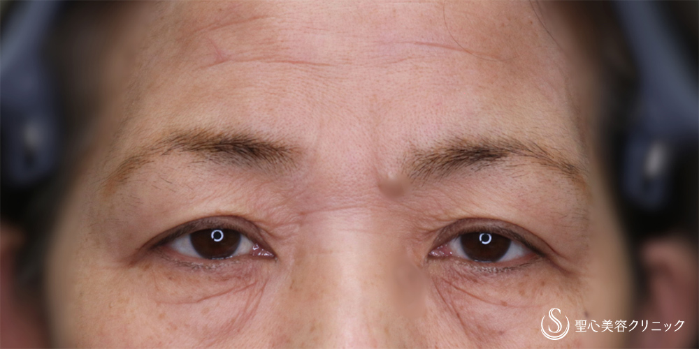 【50代女性・自然に若々しい目元に】眉下切開(術後6ヶ月) Before 