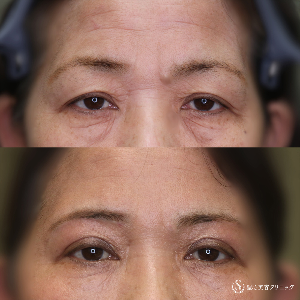 【50代女性・自然に若々しい目元に】眉下切開(術後6ヶ月) After 