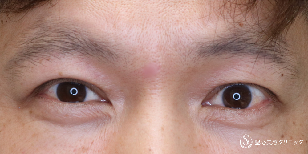 【40代男性・自然にぱっちりした目元に】二重切開+脂肪除去(術後1ヶ月) After 