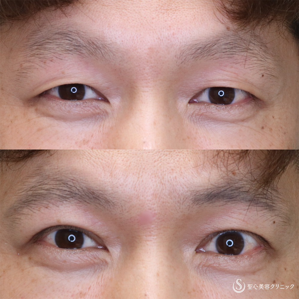 【40代男性・自然にぱっちりした目元に】二重切開+脂肪除去(術後1ヶ月) After 