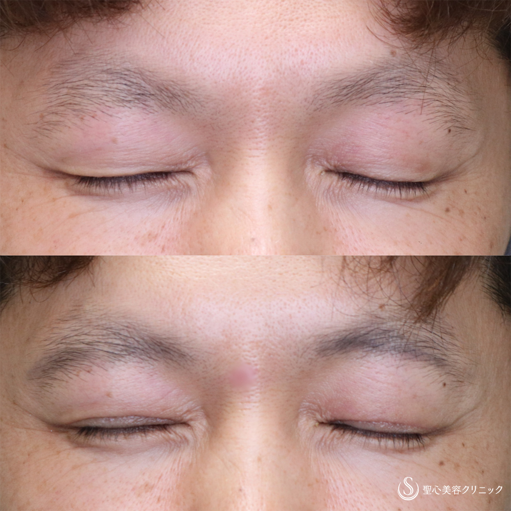 【40代男性・自然にぱっちりした目元に】二重切開+脂肪除去(術後1ヶ月) After 