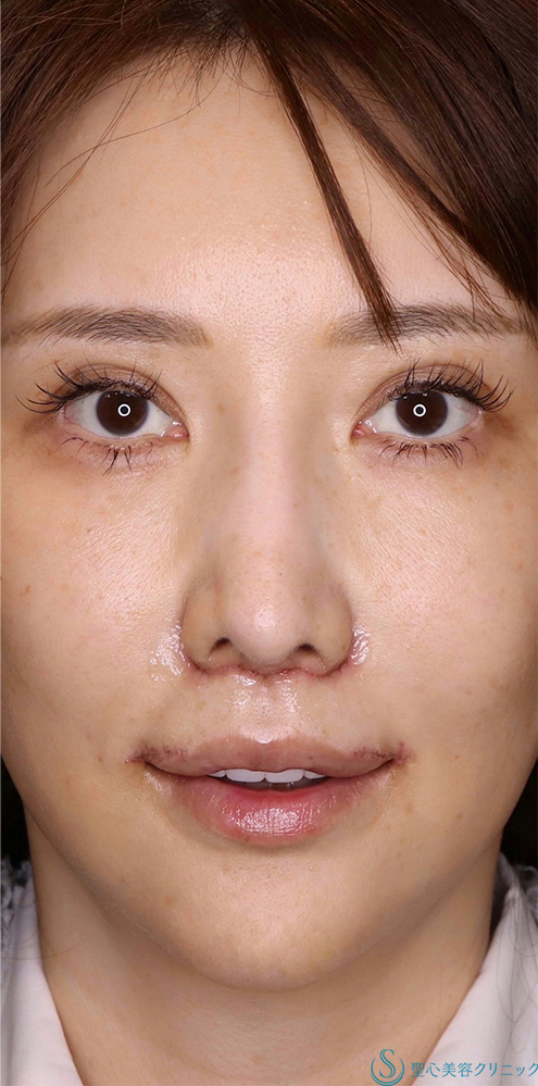 【40代女性・口元のバランスを可愛く整えたい！！】プレミアムリップリフト（プレミアム人中短縮術）＋外側人中短縮術（術後6日・抜糸時） After 