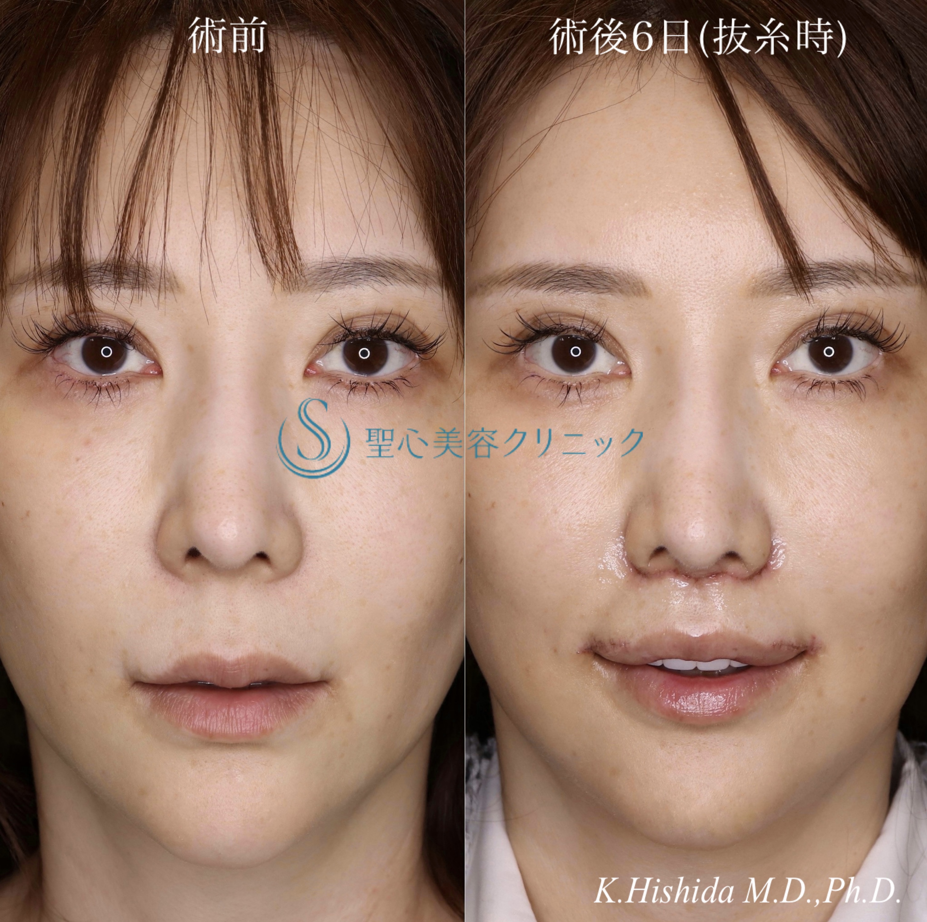 【40代女性・口元のバランスを可愛く整えたい！！】プレミアムリップリフト（プレミアム人中短縮術）＋外側人中短縮術（術後6日・抜糸時） After 