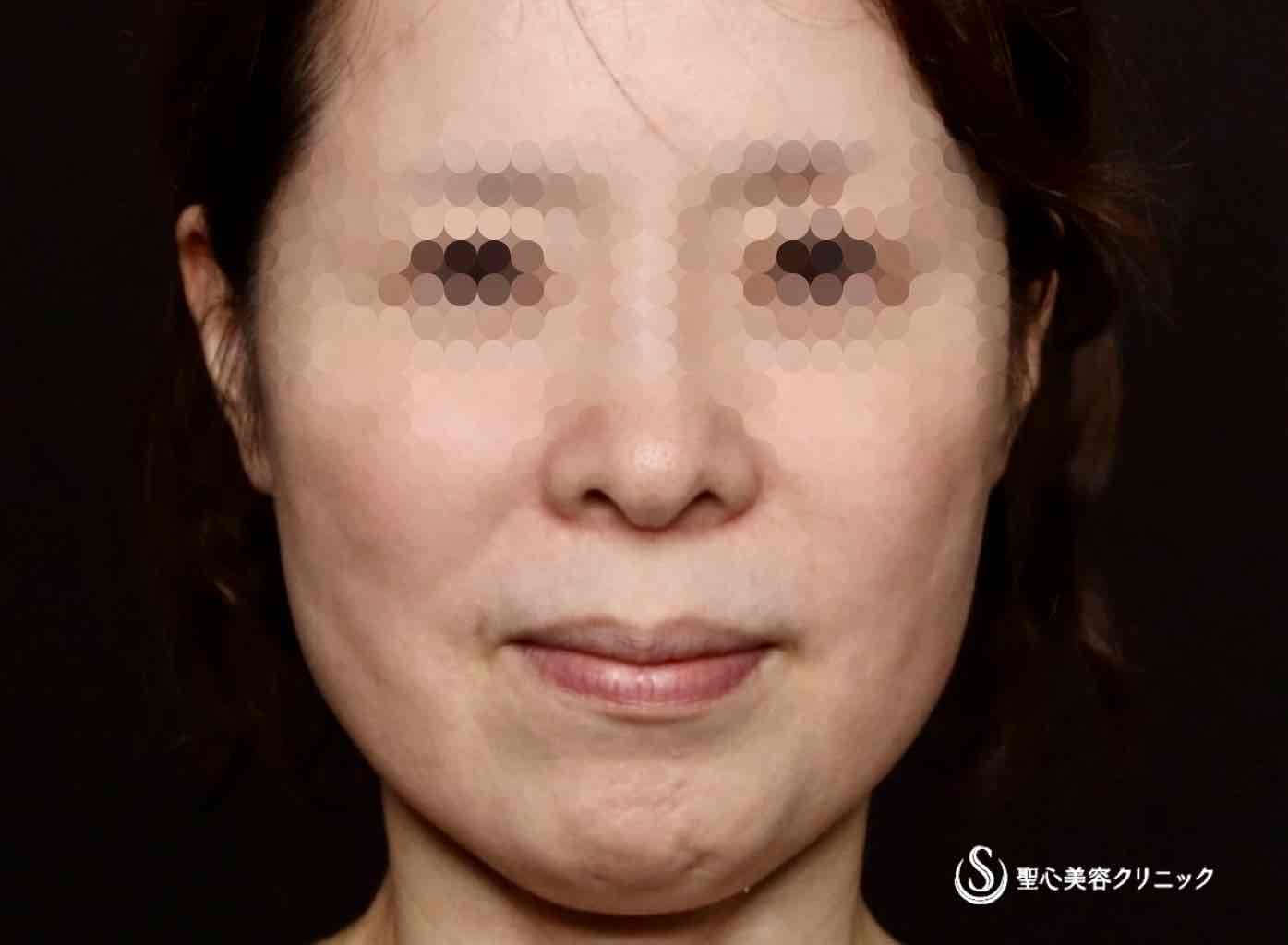 【50代女性・フェイスラインがスッキリし、頬もリフトアップ】フェイスリフト（リガメント処置＋頬、顎下脂肪吸引併用）（術後2ヶ月） Before 