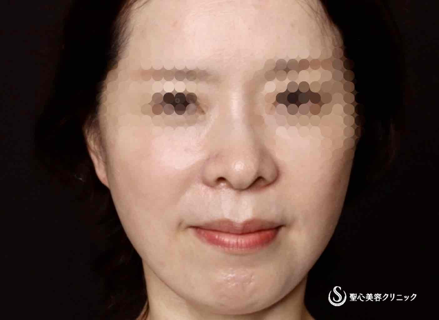 【50代女性・フェイスラインがスッキリし、頬もリフトアップ】フェイスリフト（リガメント処置＋頬、顎下脂肪吸引併用）（術後2ヶ月） After 