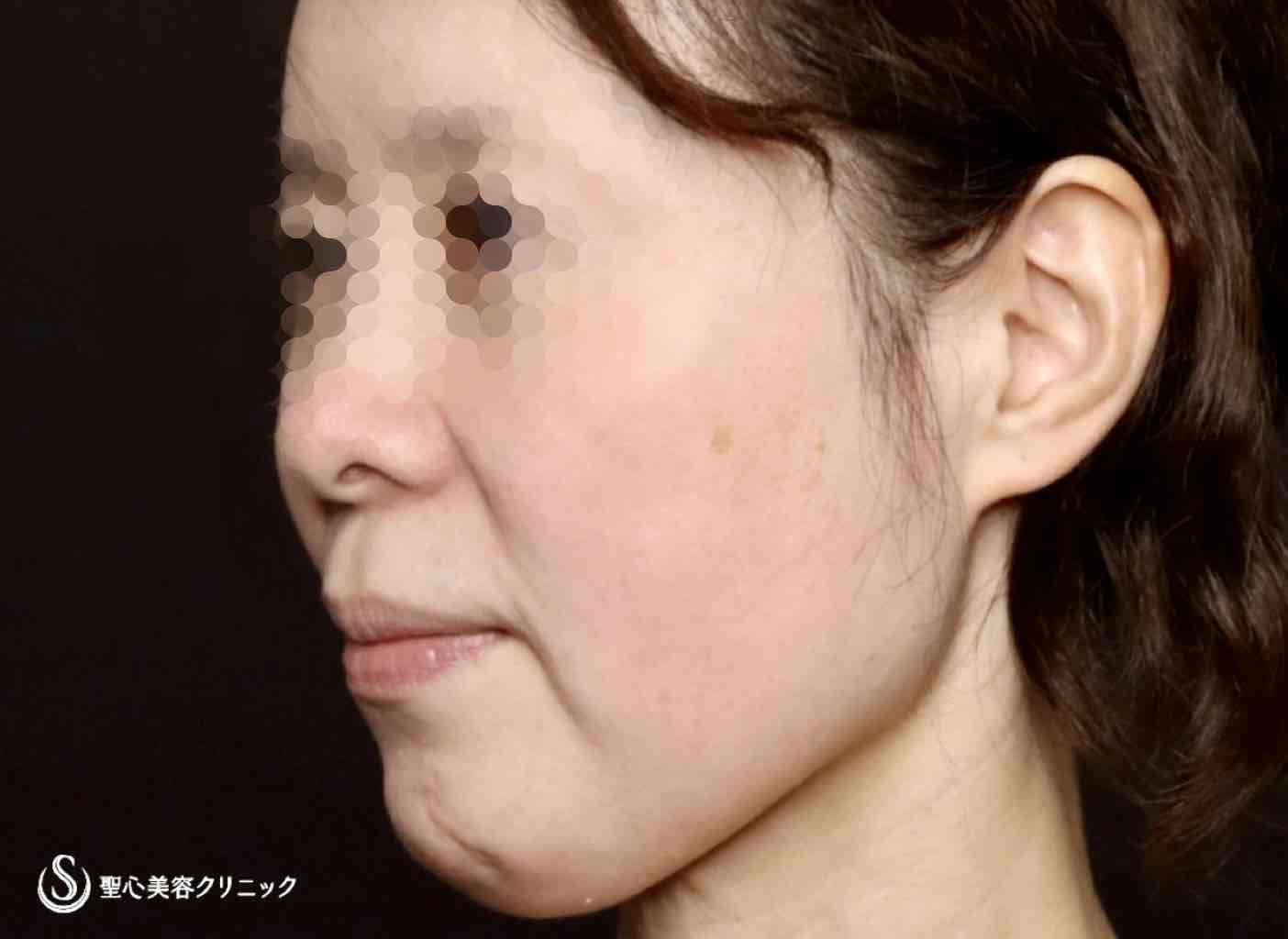 【50代女性・フェイスラインがスッキリし、頬もリフトアップ】フェイスリフト（リガメント処置＋頬、顎下脂肪吸引併用）（術後2ヶ月） Before 