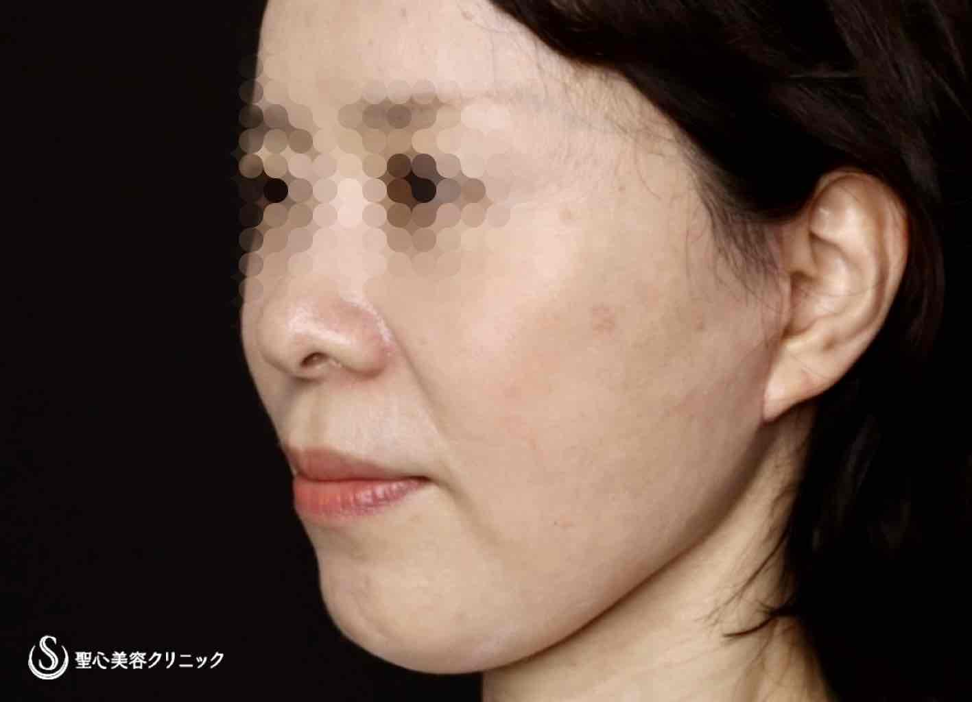 【50代女性・フェイスラインがスッキリし、頬もリフトアップ】フェイスリフト（リガメント処置＋頬、顎下脂肪吸引併用）（術後2ヶ月） After 