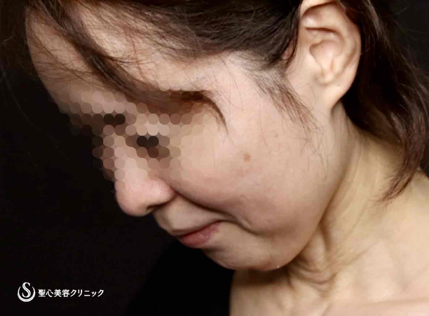 【50代女性・フェイスラインがスッキリし、頬もリフトアップ】フェイスリフト（リガメント処置＋頬、顎下脂肪吸引併用）（術後2ヶ月） Before 