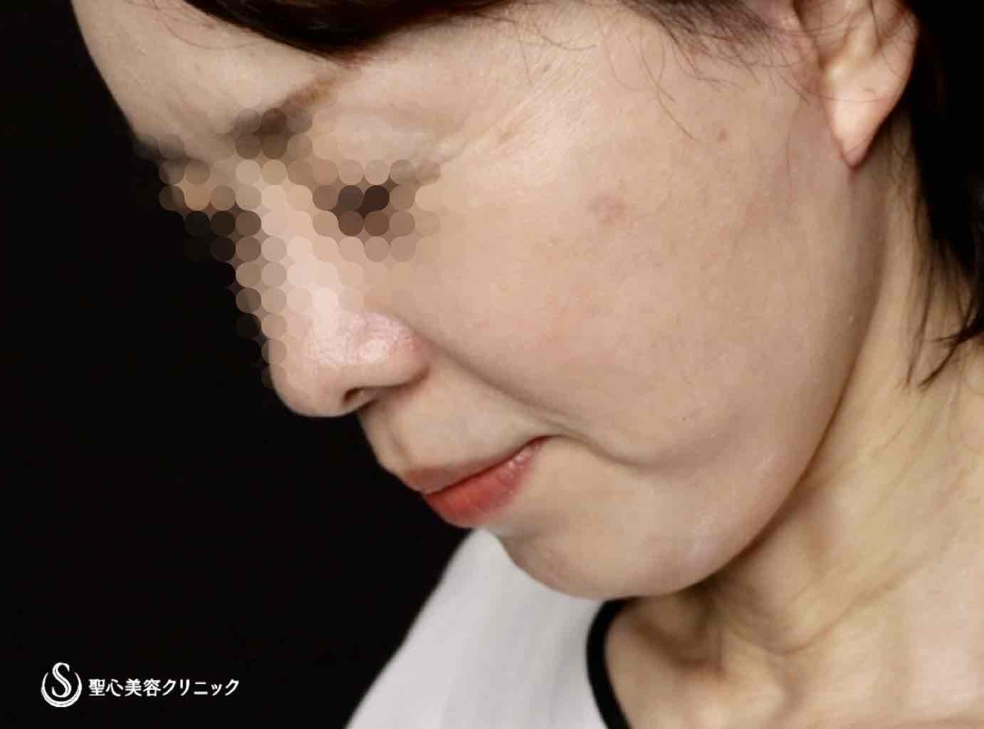 【50代女性・フェイスラインがスッキリし、頬もリフトアップ】フェイスリフト（リガメント処置＋頬、顎下脂肪吸引併用）（術後2ヶ月） After 