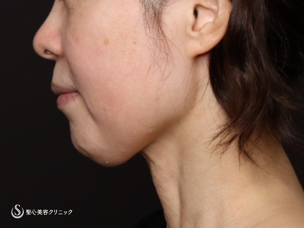 【50代女性・フェイスラインがスッキリし、頬もリフトアップ】フェイスリフト（リガメント処置＋頬、顎下脂肪吸引併用）（術後2ヶ月） Before 