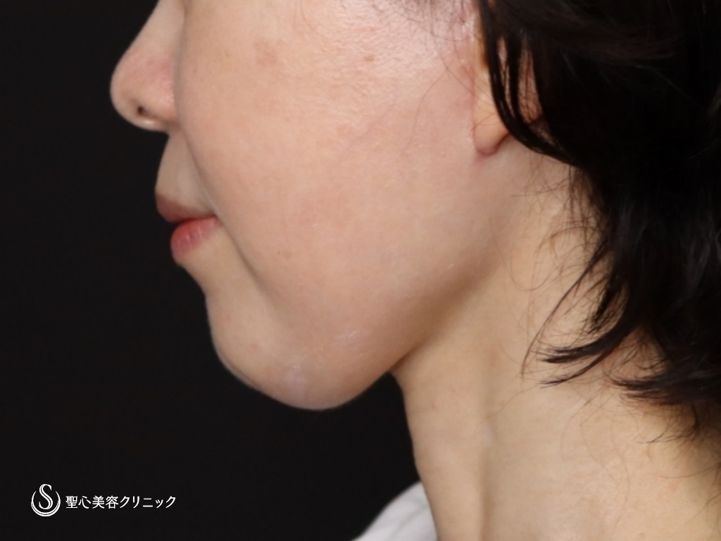 【50代女性・フェイスラインがスッキリし、頬もリフトアップ】フェイスリフト（リガメント処置＋頬、顎下脂肪吸引併用）（術後2ヶ月） After 